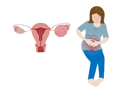 Ovarian cancer surgery, treatment, and post-operative care